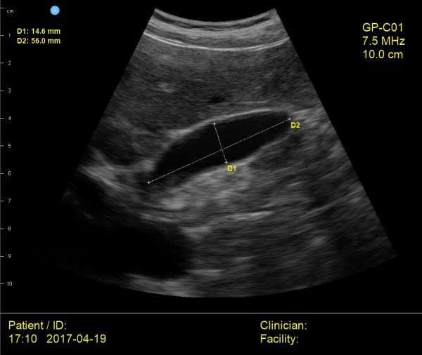 AMD ultrasound probe_gallbladder
