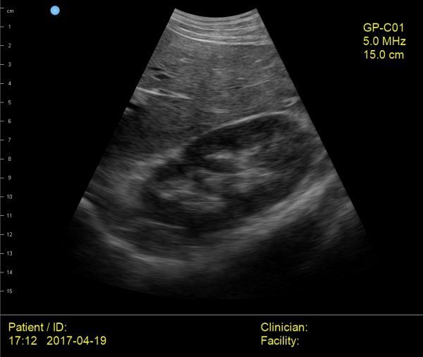 AMD ultrasound probe_liver-kidney